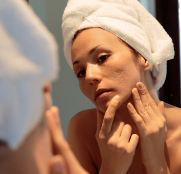 Frau mit Aknenarben im Spiegel