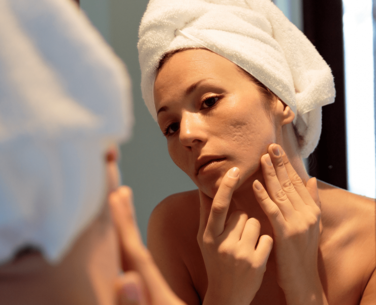 Frau mit Aknenarben im Spiegel