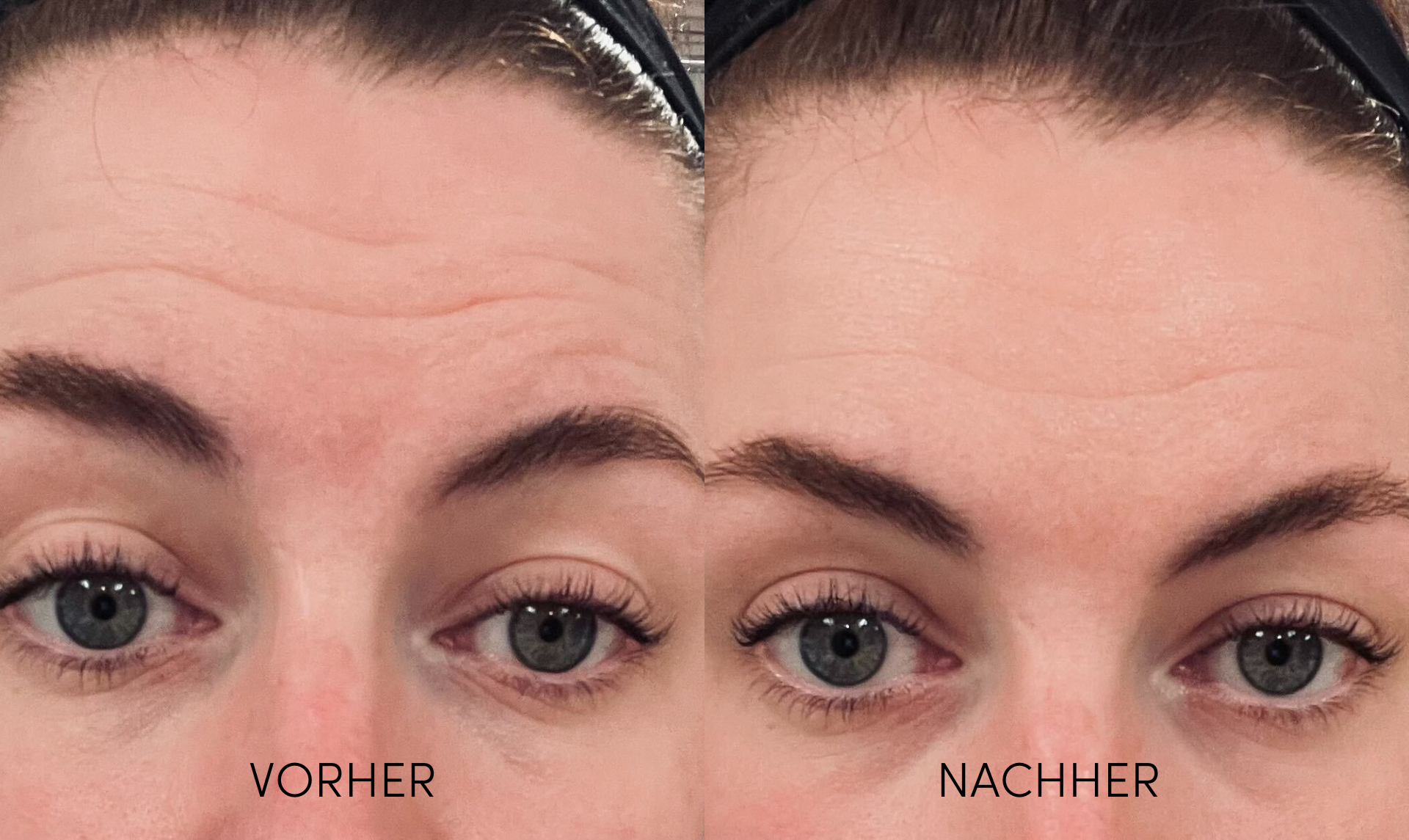 Botoxeffekt ganz ohne Spritze oder Nebenwirkungen