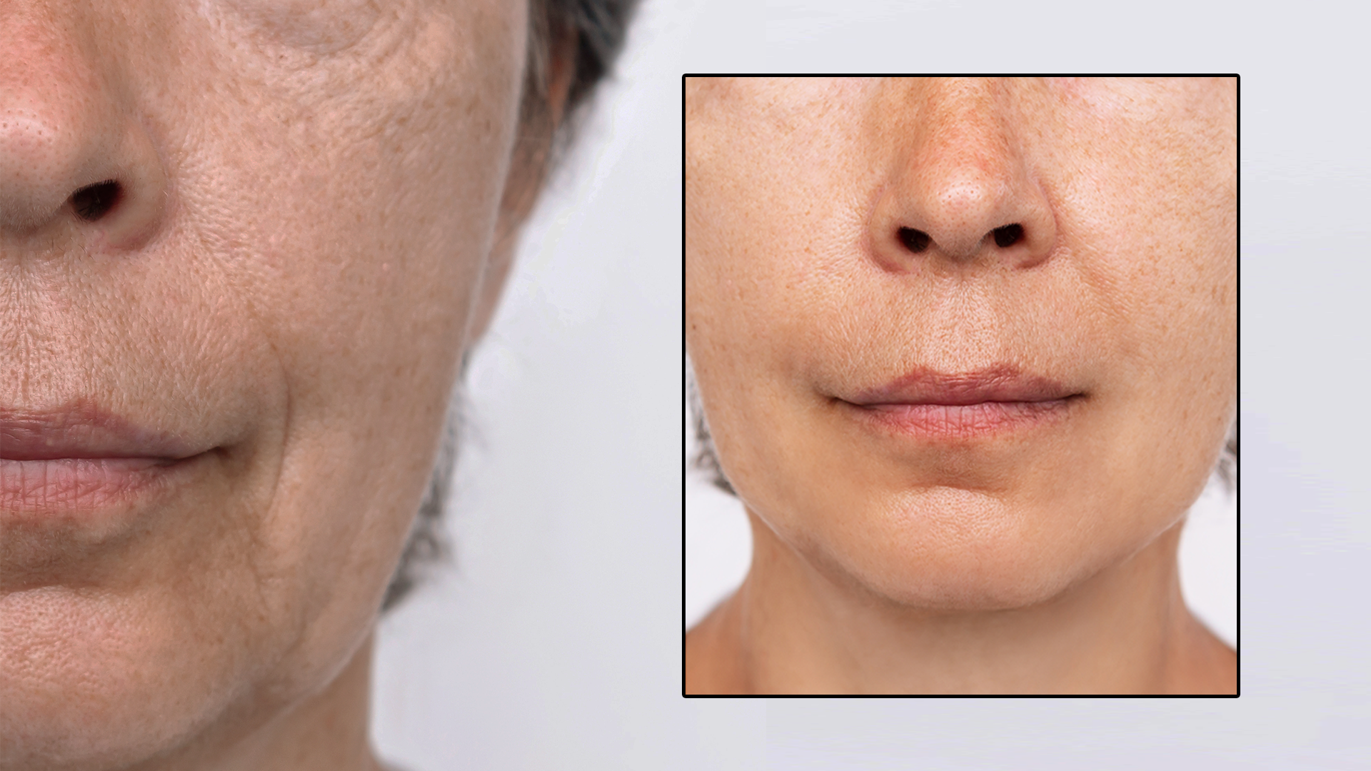 Sorgt für eine aufgepolsterte, faltenfreie Haut - bereits innerhalb weniger Wochen!