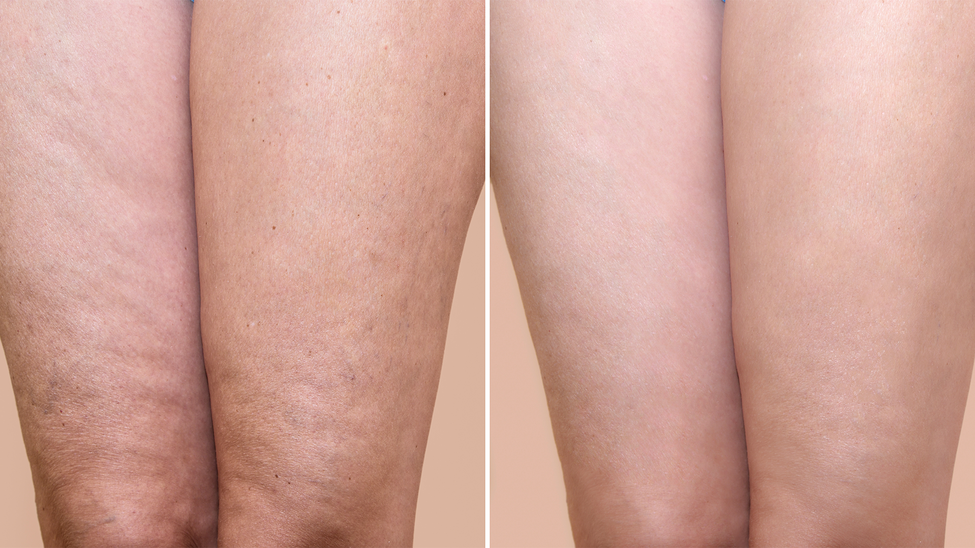 Stärkt nachweislich das Bindegewebe und wirkt damit Cellulite entgegen